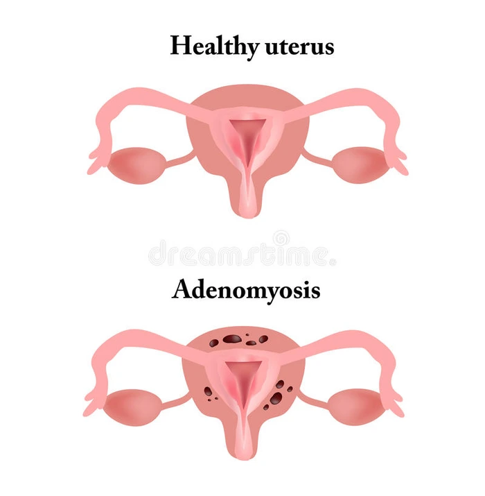 子宫内膜异位症 盆腔器官的结构 子宫腺肌病 子宫内膜 矢量插图