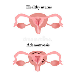 子宫内膜异位症。 盆腔器官的结构。 子宫腺肌病。 子宫内膜。 矢量插图