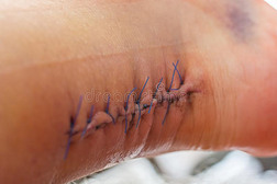 外科的缝合向指已提到的人脚后跟关于一m一n一ftersurgic一ltre一tment关于