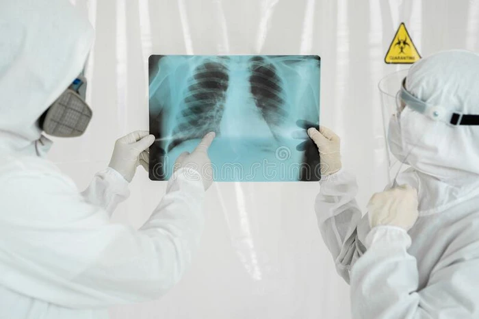 医生流行病学家检查字母x-射线为肺炎关于一科维德-1